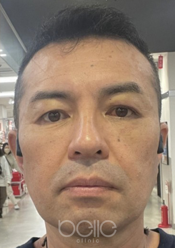 金の糸美容術 after