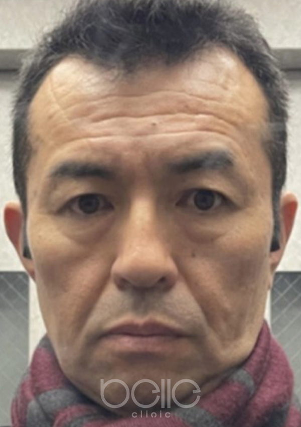 金の糸美容術 before