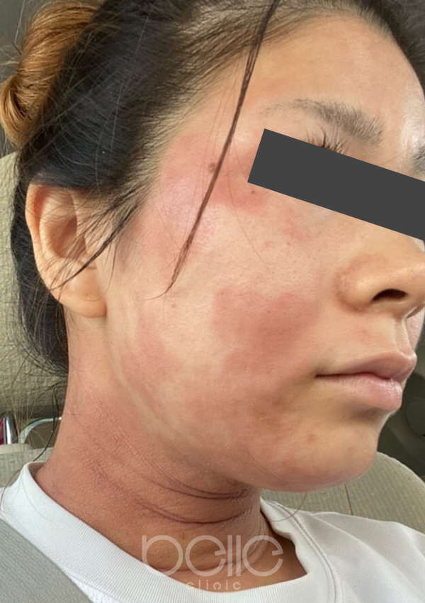 金の糸美容術 before