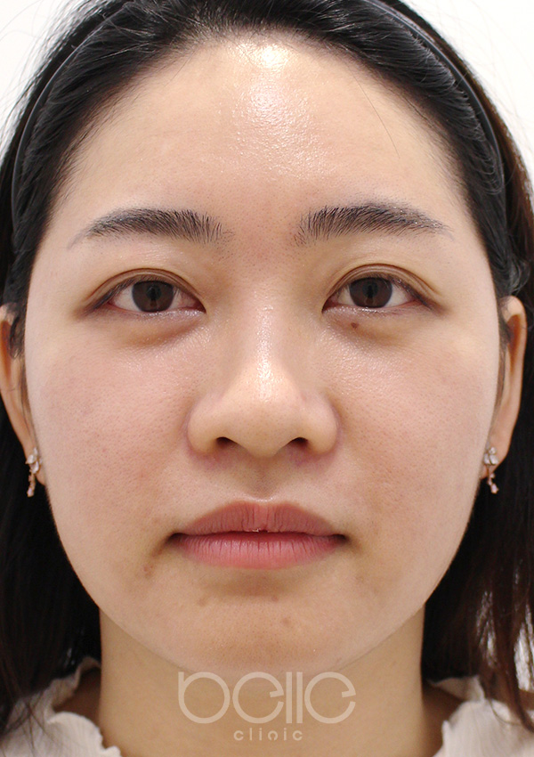 金の糸美容術 6ヶ月後