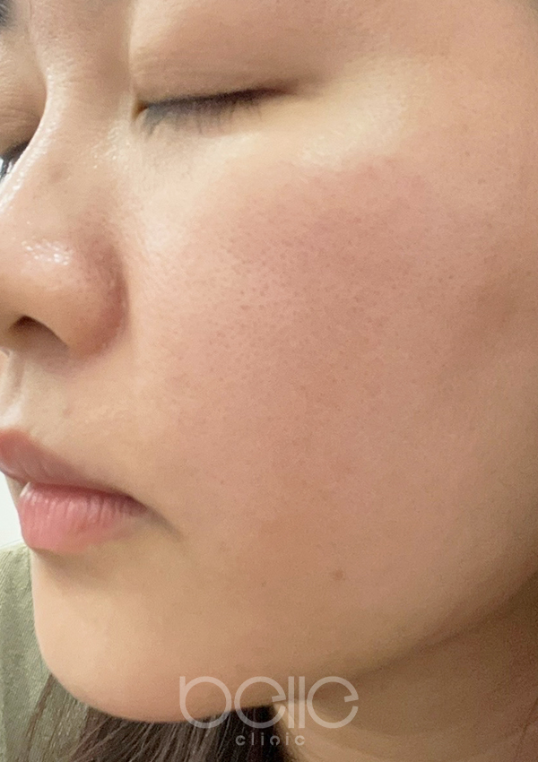 金の糸美容術 2年3ヶ月後