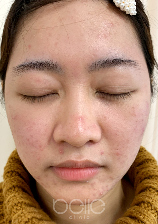 金の糸美容術 before