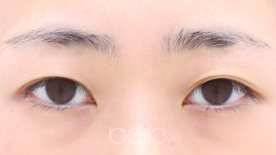 施術名&nbsp;&nbsp;NO.B000X Before：施術前