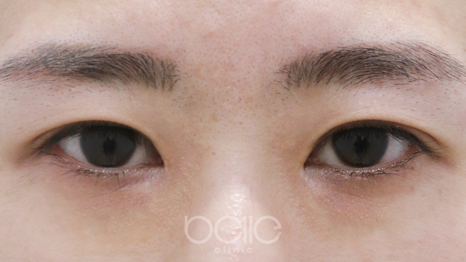 二重埋没 Before：施術前