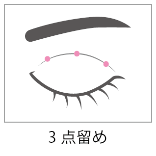 埋没法3点留め